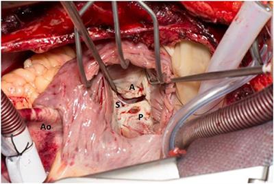 Surgical Correction of Carcinoid Heart Disease Improves Liver Function and 5-Hydroxyindoleacetic Acid Levels